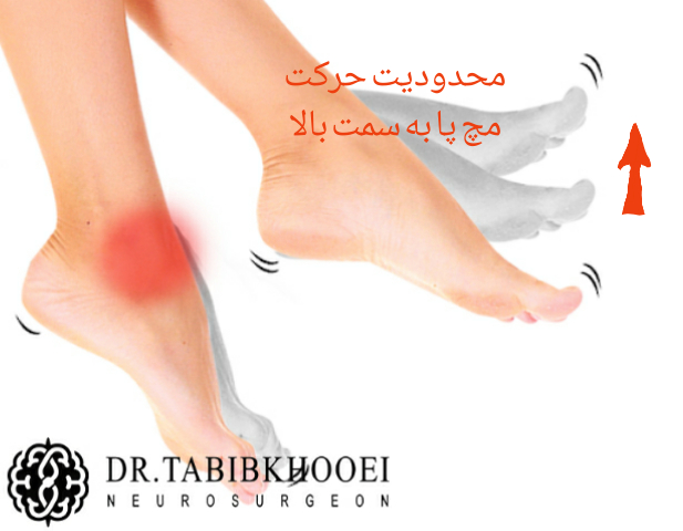 بیحسی پا در بیرون زدن دیسک کمر