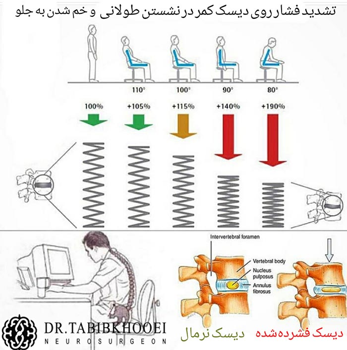 تشدید فشار روی دیسکهای کمر