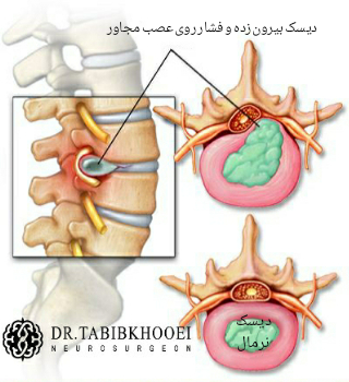 پارگی دیسک کمر