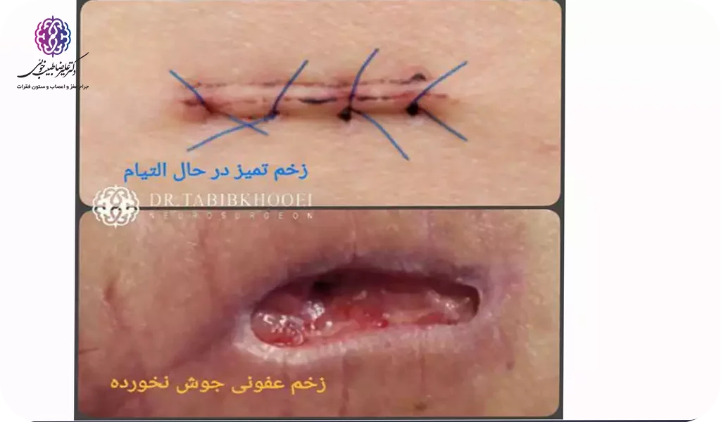 پانسمان و مراقبت از زخم بعد از جراحی تنگی کانال گردنی