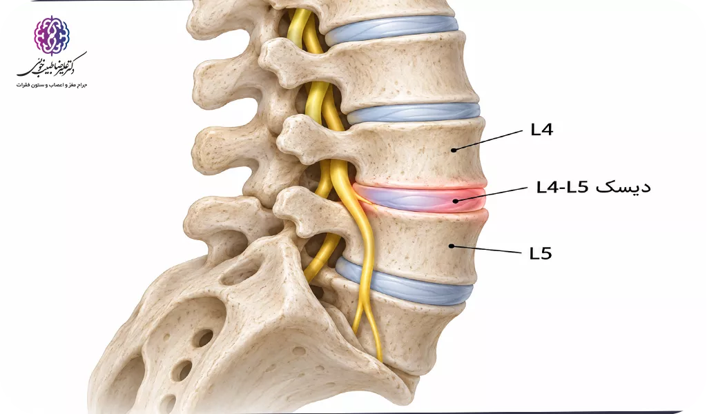 جراحی دیسک L4-L5