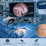 جراحی دیسک کمر به روش آندوسکوپی