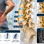 لقی مهره کمر چیست